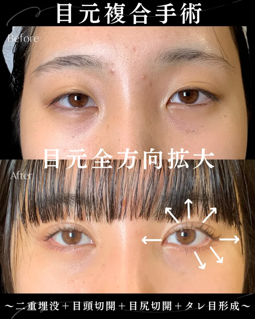 二重埋没法+目頭切開+目尻切開+タレ目形成(名医の岩井勝矢)