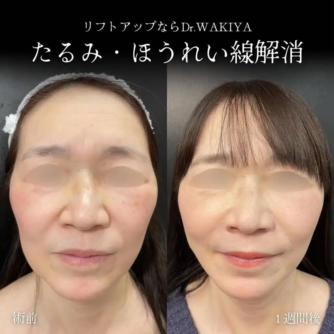 ほうれい線のヒアルロン酸注入の症例写真