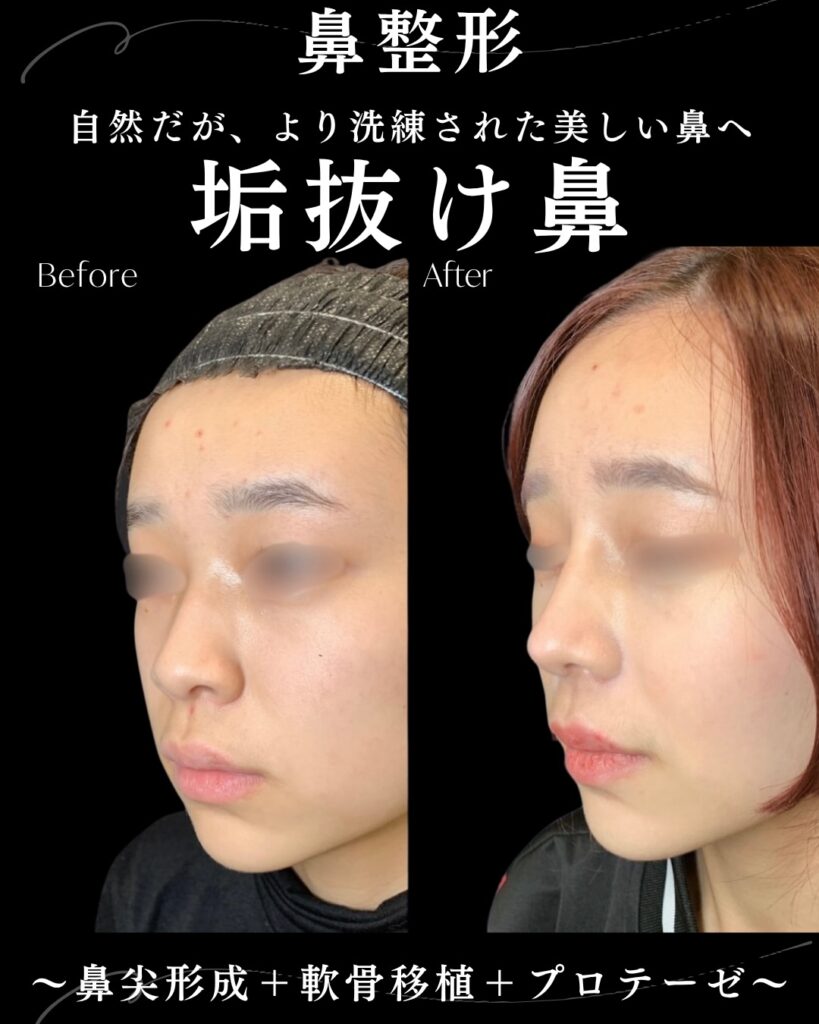 鼻尖形成と軟骨移植とプロテーゼの症例写真 (4)
