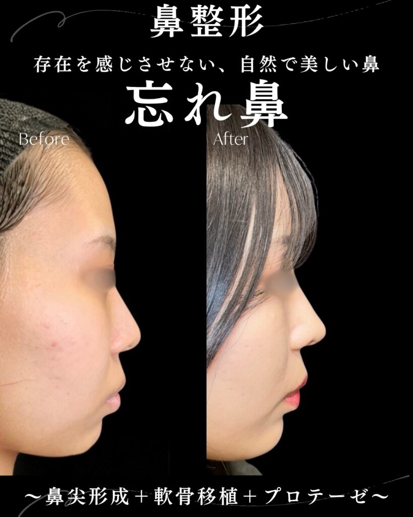 鼻尖形成と軟骨移植とプロテーゼの症例写真 (2)