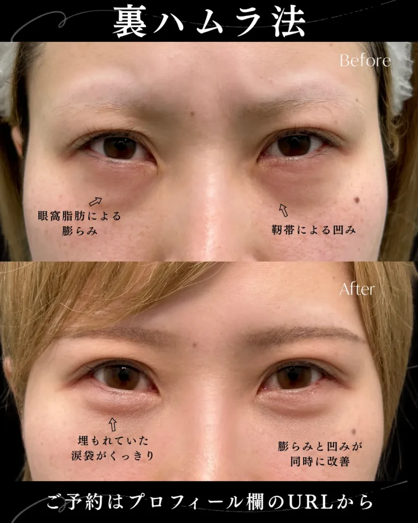 クマ取り_裏ハムラ法(名医の岩井勝矢)