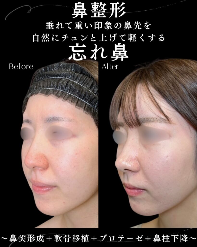 鼻尖形成と軟骨移植の症例写真