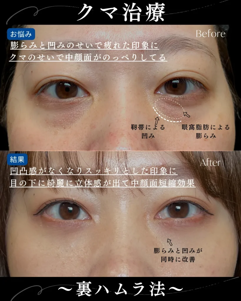 クマ取り_裏ハムラ法(名医の岩井勝矢)