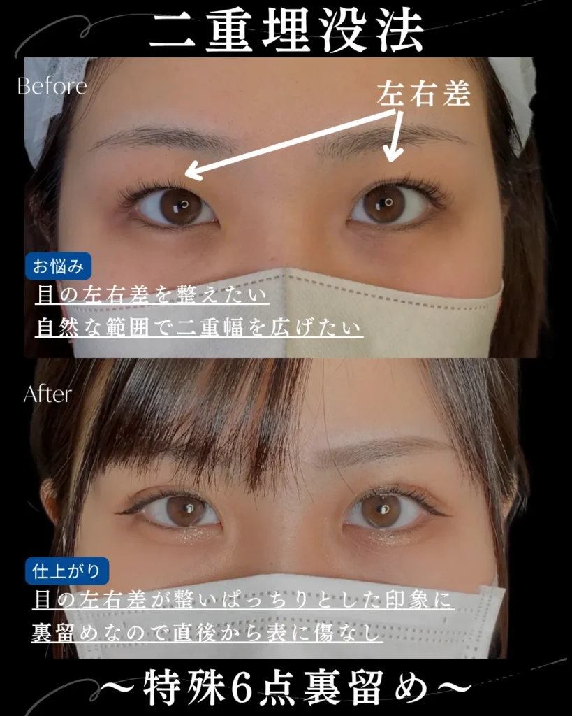 二重埋没法_特殊6点裏留め(名医の岩井勝矢)