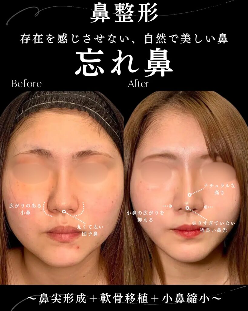 鼻尖形成と軟骨移植と小鼻縮小の症例写真