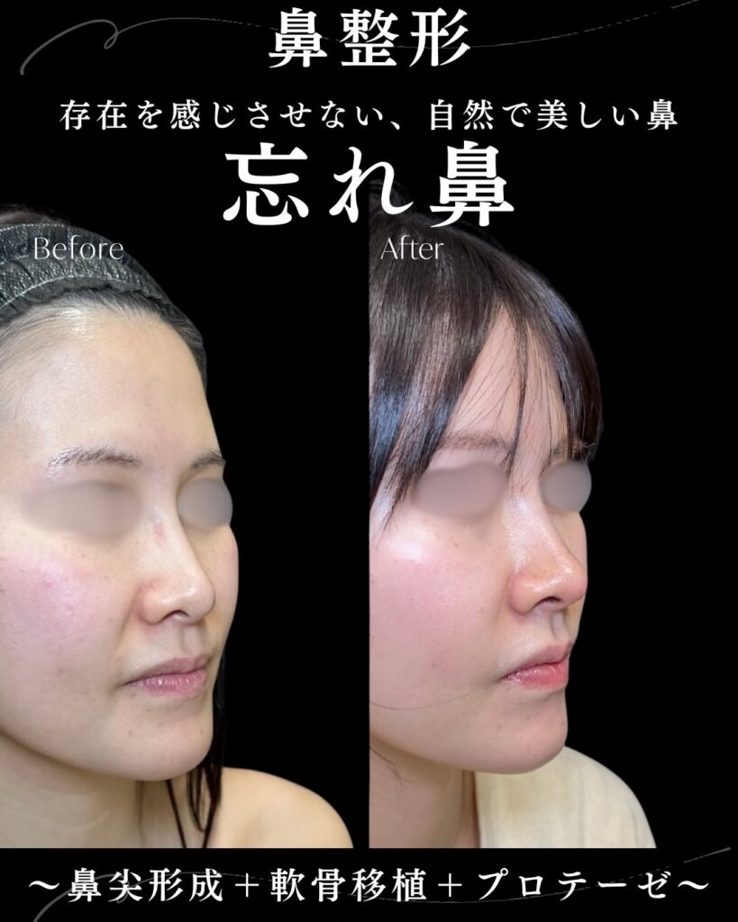 鼻尖形成と軟骨移植とプロテーゼの症例写真