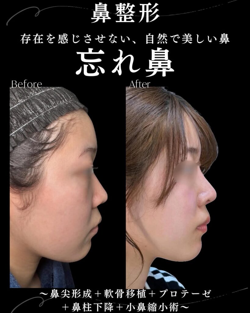 鼻尖形成と軟骨移植と鼻柱下降と小鼻縮小とプロテーゼの症例写真