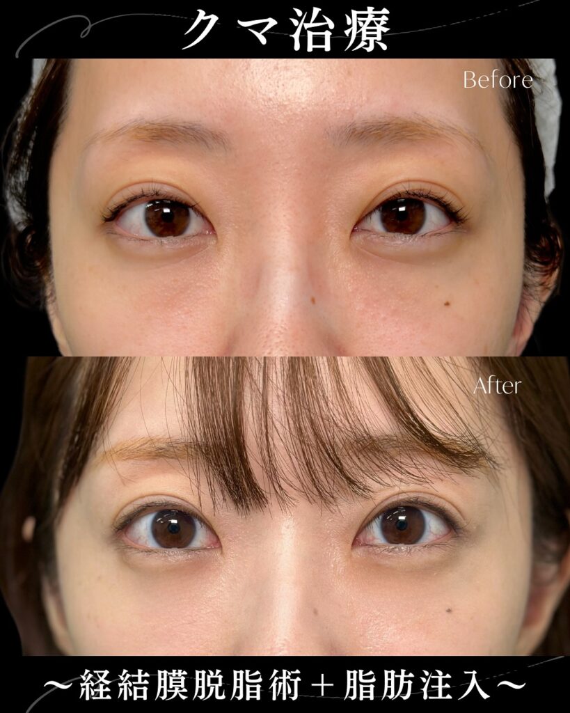脱脂と脂肪注入の症例写真 (3)