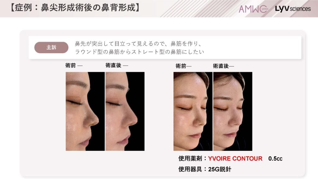 24_症例:鼻尖形成術後の鼻背形成
