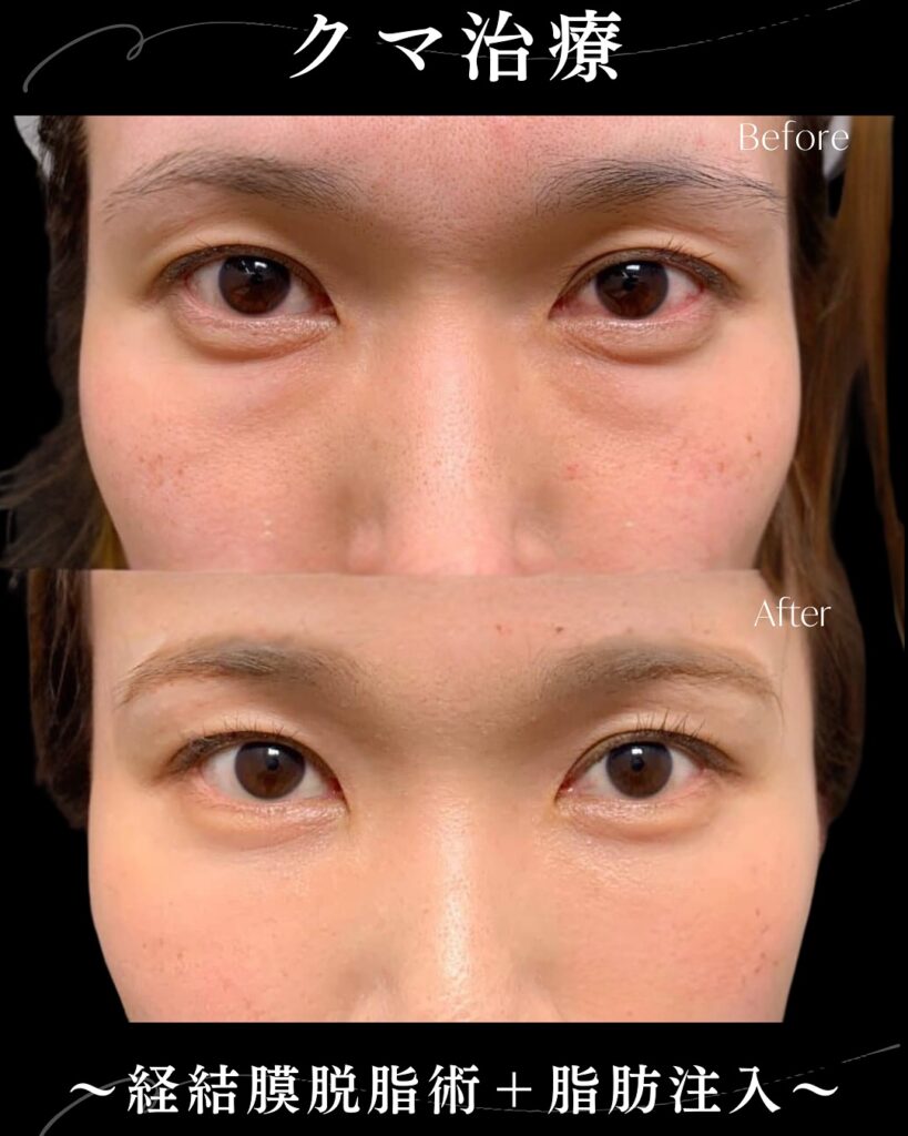 脱脂と脂肪注入の症例写真 (2)
