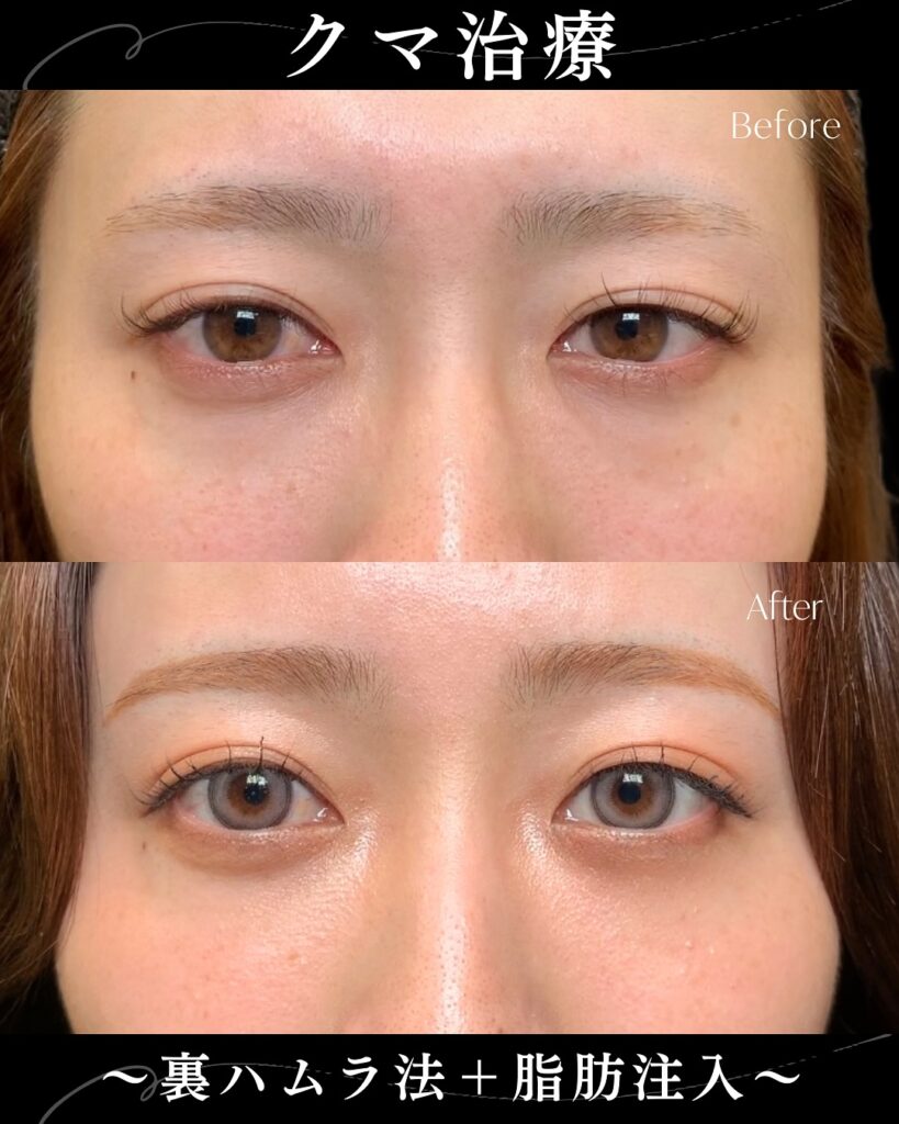 裏ハムラ法と脂肪注入の症例写真 (2)