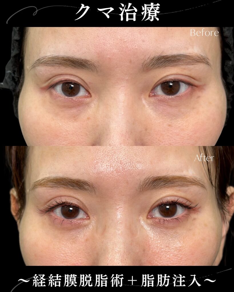 脱脂と脂肪注入の症例写真